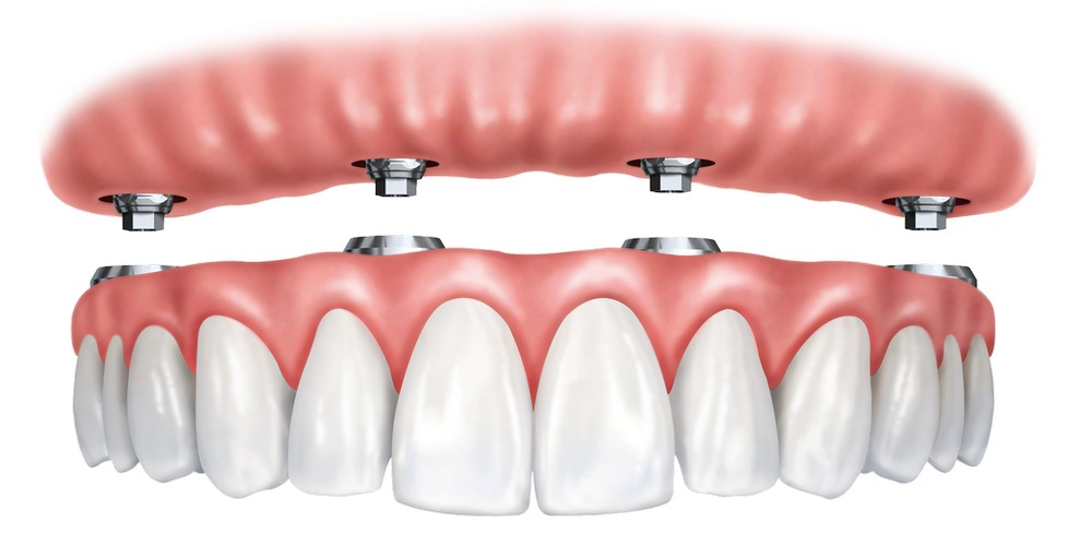 Имплантация зубов с немедленной нагрузкой протезом