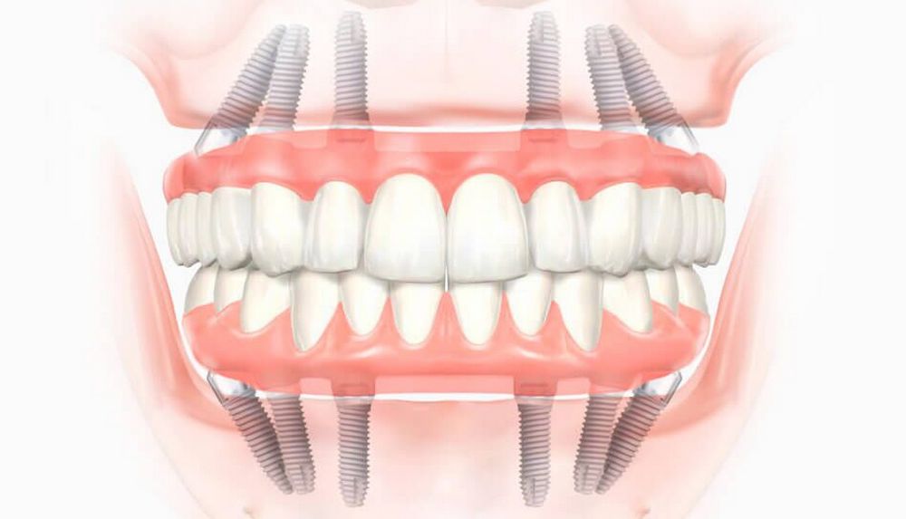Метод одномоментной имплантации зубов