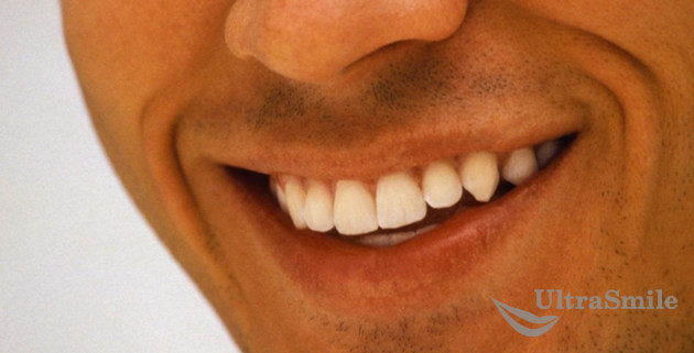 улыбка-реставрация зубов