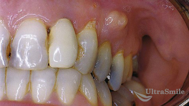 Показания к удалению зуба при флюсе