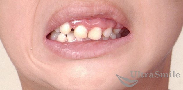 Неправильное положение зубов у ребенка 