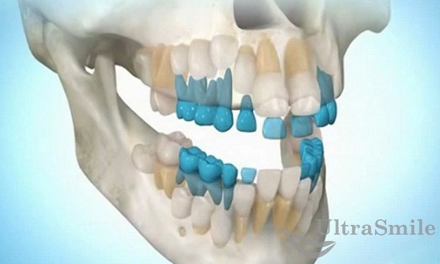 Смена молочных зубов на постоянные - удаление молочных зубов