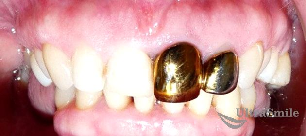 Золотые коронки на передние зубы