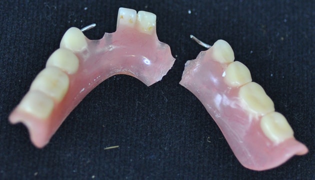 Поврежденный зубной протез