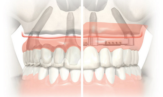 Метод комплексного восстановления зубов All-on-4