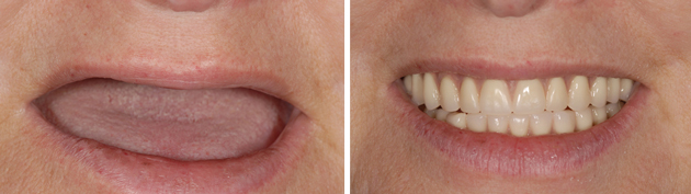 Базальная имплантация на все зубы, фото до и после