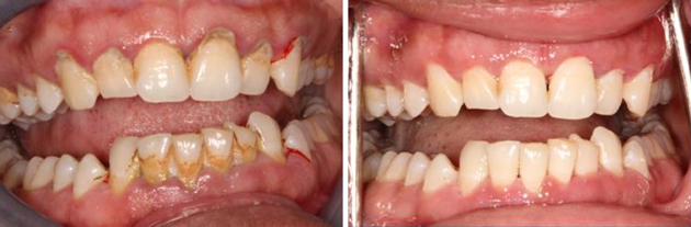 Фото зубов до и после лечения гингивита