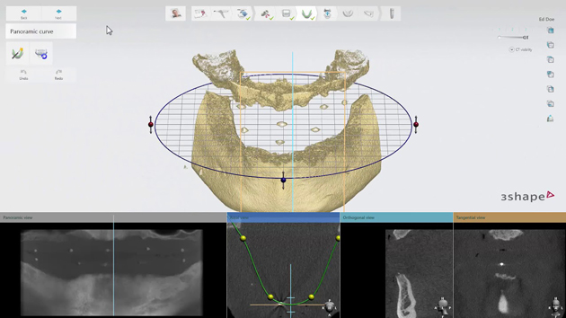 3D моделирование определяет точность во вживлении имплантов
