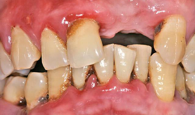 Пародонтит тяжелой формы приводит к потере зубов