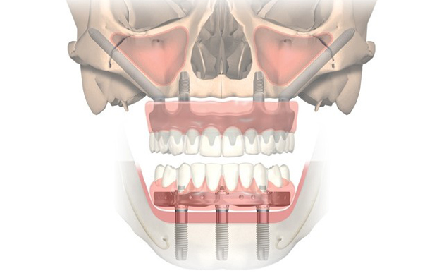 На верхнюю челюсть довольно часто устанавливают скуловые импланты Zygoma