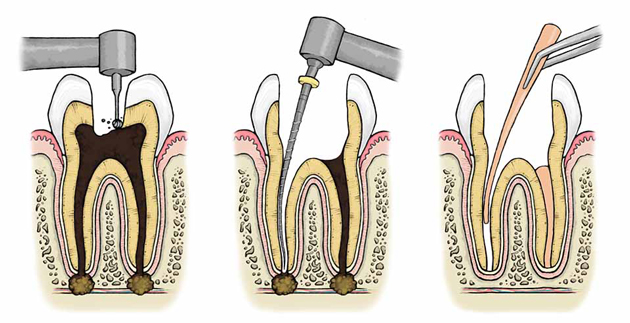 Эластичный материал хорошо герметизирует полости зуба