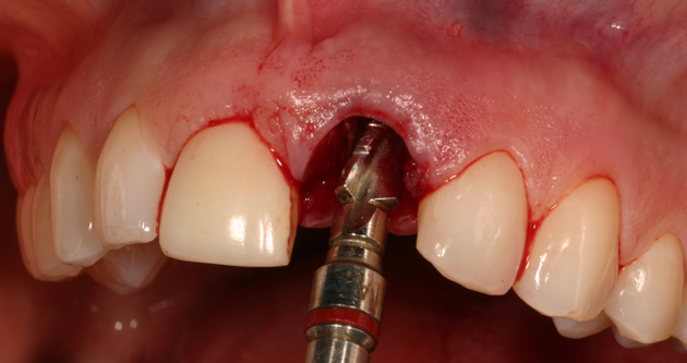 На фото изображена установка импланта в лунку сразу после удаления зуба