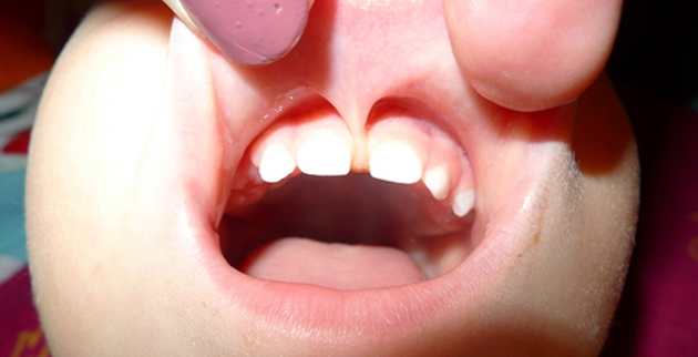 Короткая уздечка верхней губы вызывает щель