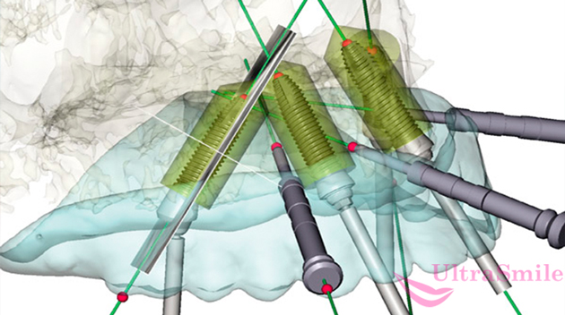 3D моделирование будущей имплантации зубов
