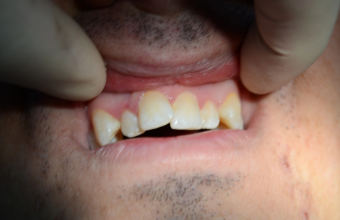 5 методов лечения скученности зубов