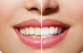5 секретов, как безопасно отбелить зубы содой