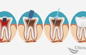 Лечение зубных каналов по акции