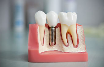 Что такое имплантация зубов: 4 распространенных метода