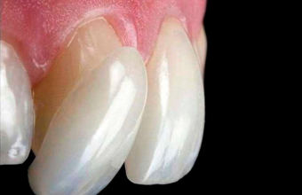 4 причины, почему нельзя провести протезирование винирами без обточки зубов