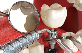 Как делается имплантация зубов: 5 шагов, которые нужно пройти