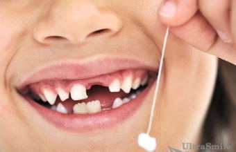 5 поводов отказаться от удаления молочных зубов