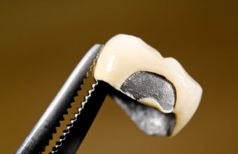 5 способов, как снять искусственную коронку с зуба