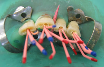 Гуттаперча в стоматологии: 6 преимуществ использования