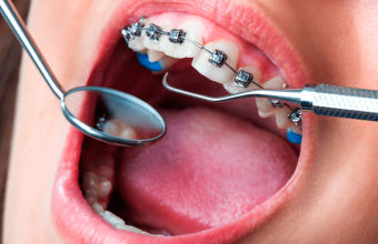 Как ставят брекеты на зубы: этапы и особенности, на которые важно обратить внимание