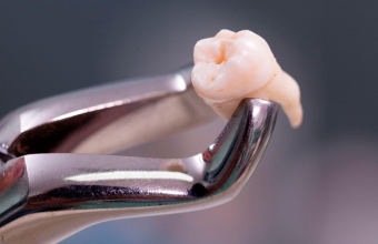 5 этапов, из которых состоит удаление зуба