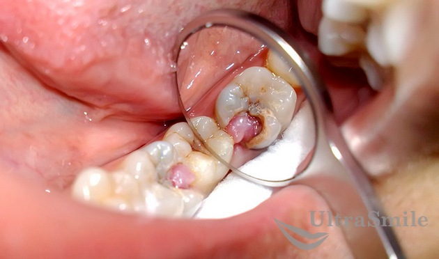После лечения пульпита ноет зуб что это thumbnail