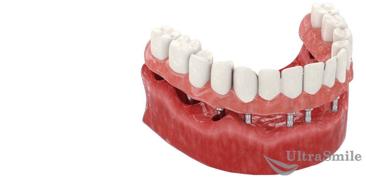 Комплексная базальная имплантация зубов - акция