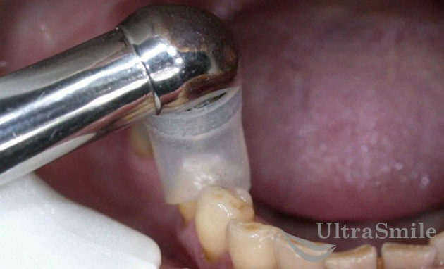 Лечение зубов без бормашинки thumbnail