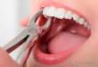 4 полезных совета, которые помогут подготовиться к удалению зубов