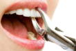 10 последствий после удаления зуба, которые считаются нормой
