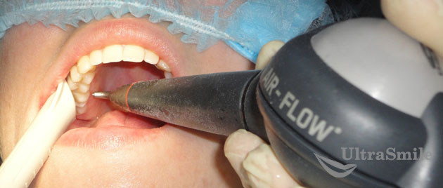 Лечение зубов после брекетов thumbnail