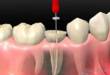 Пульпит зуба у взрослых: симптомы и формы заболевания