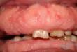 Гиперплазия или разрастание десны во рту – как лечить?