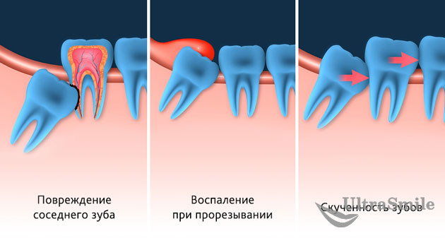 Почему стоматологи не лечат зубы мудрости