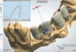 Технология CAD/CAM: когда протез может быть идеальным