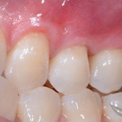 Чистка и отбеливание зубов