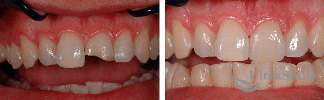 Лечение скола переднего зуба thumbnail