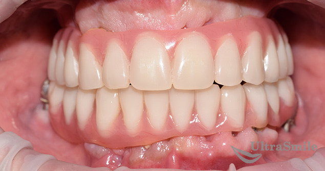 комплексная имплантация зубов до и после