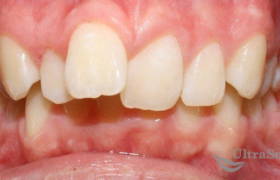 Исправление скученности зубов до и после