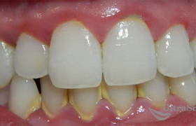 Лечение десен и чистка зубного налета