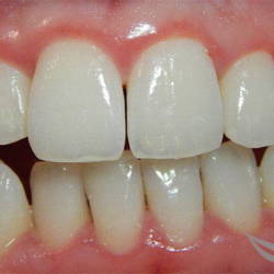 Лечение десен и чистка зубного налета