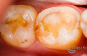 Лечение зубов и установка пломбы