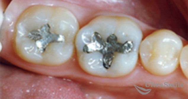 Замена зубных пломб до и после