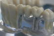 7 названий имплантации зубов по протоколу немедленной нагрузки. Как не запутаться?