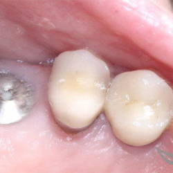 Имплантация жевательного зуба до и после