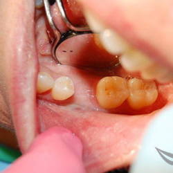 Экспресс имплантации зубов до и после